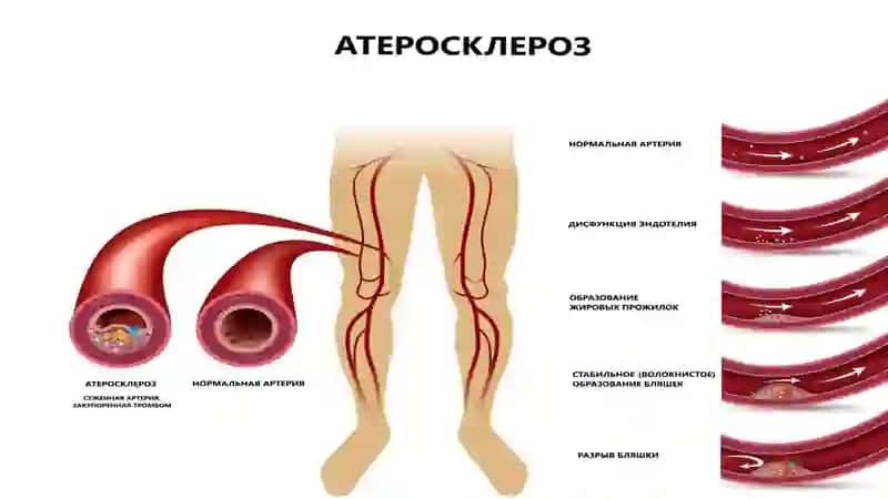 Tomirlarning surunkali arterial obliteratsiyasini davolashning zamonaviy usullari/Современные методы лечения хронической артериальной облитерации сосудов 4