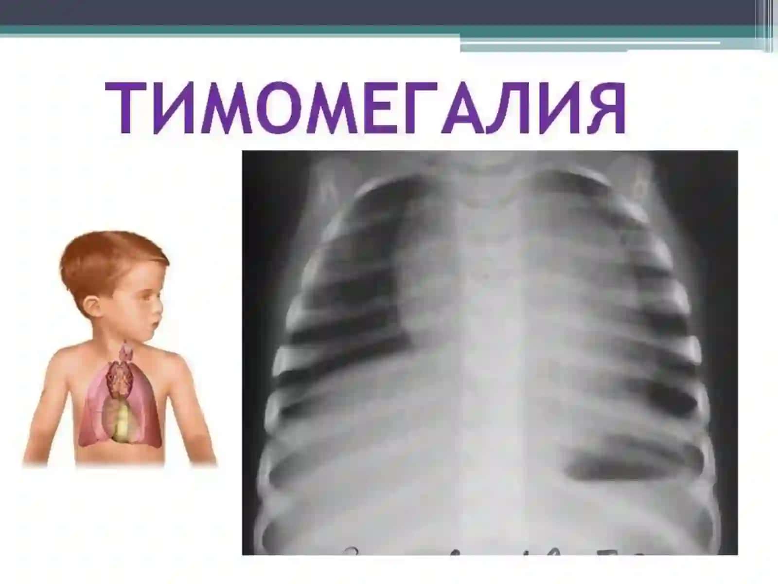 Timomegaliya 4