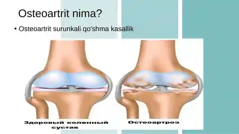 Osteoartritnima 4