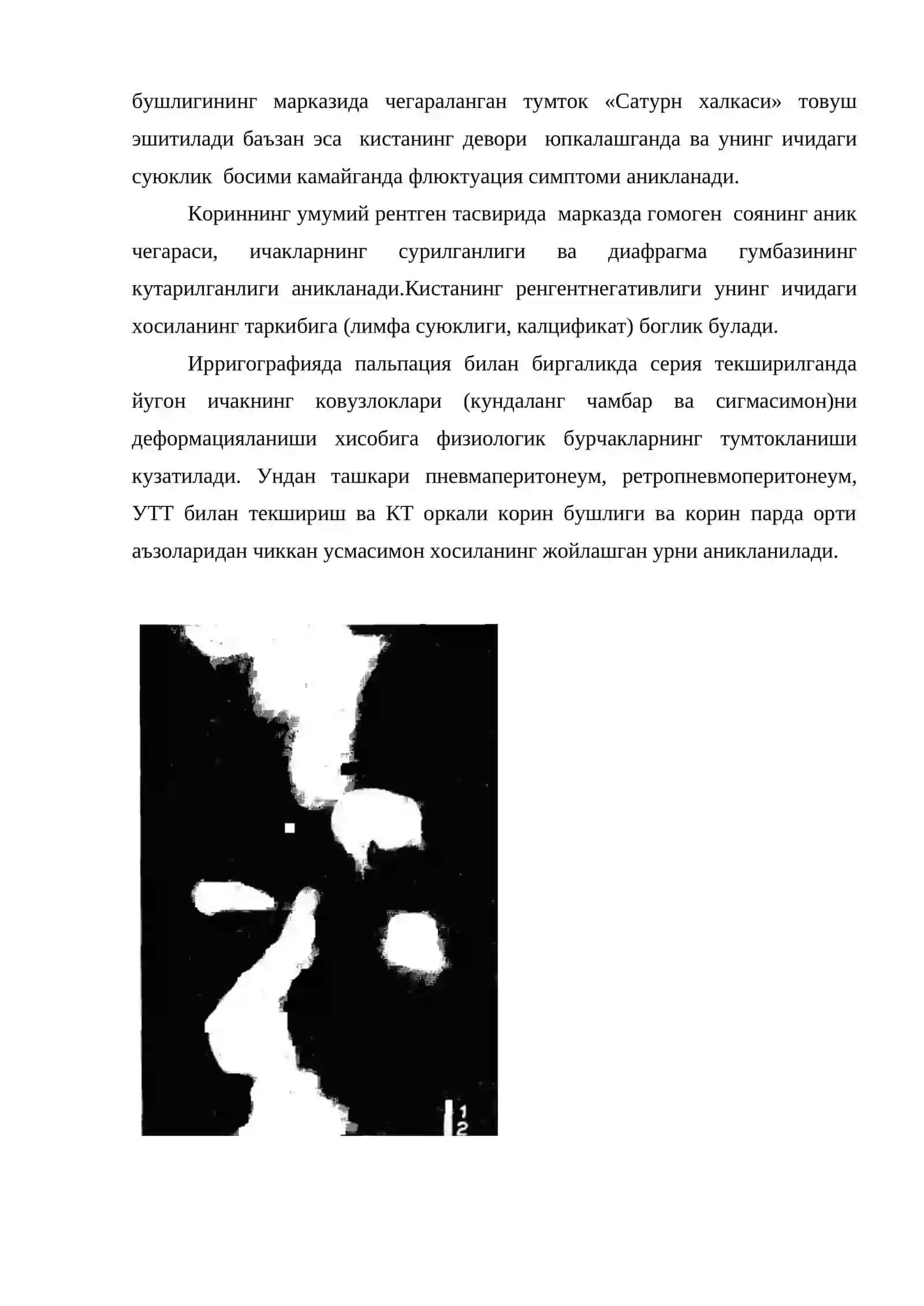 Болаларда корин бушлигида пайпасланувчи хосила синдроми 4