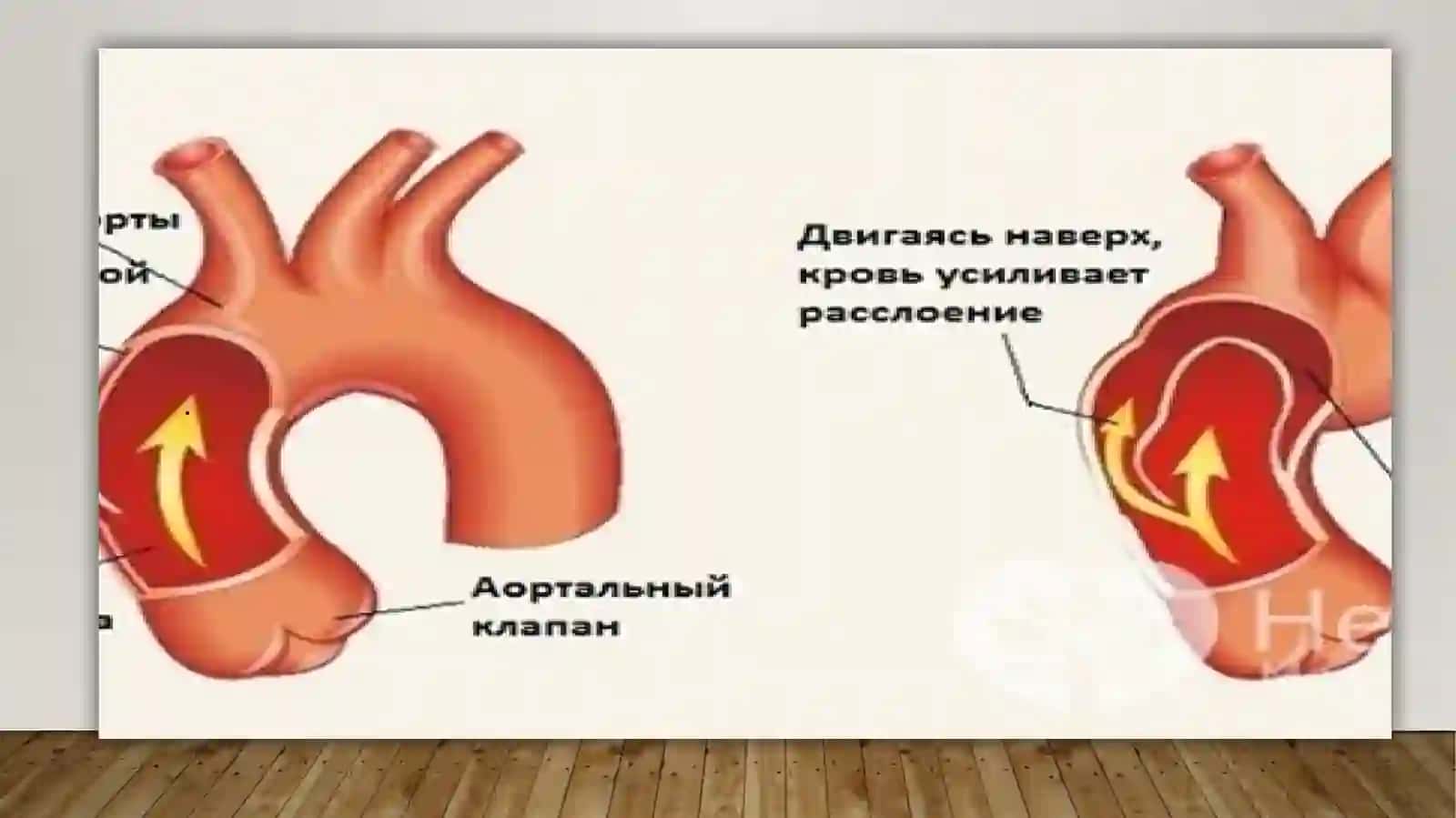 Aortaning rivojlanish nuqsonlari 4