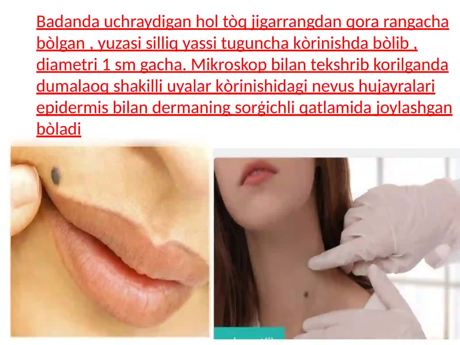 NEVUSLAR 4