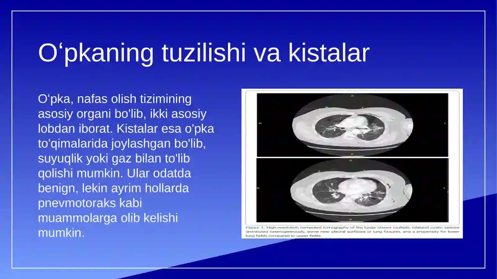 Oʻpkaning Noinvaziv Kistallari va Spontan Pnevmotoraks 4