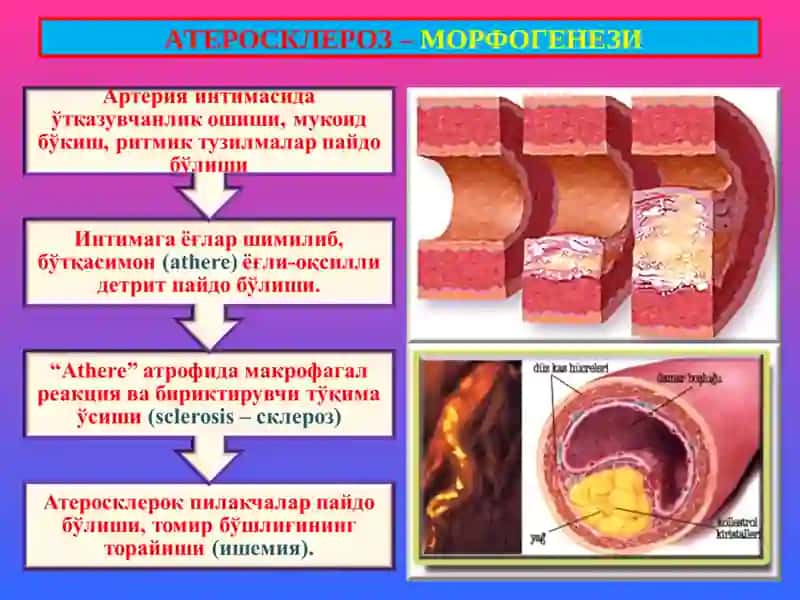 Қон томирлар патологияси. Томир аномалиялари. Гипертензия. Атеросклероз. Аневризмалар. Юрак патологияси Туғма юрак пороклари. ЮИК. 4