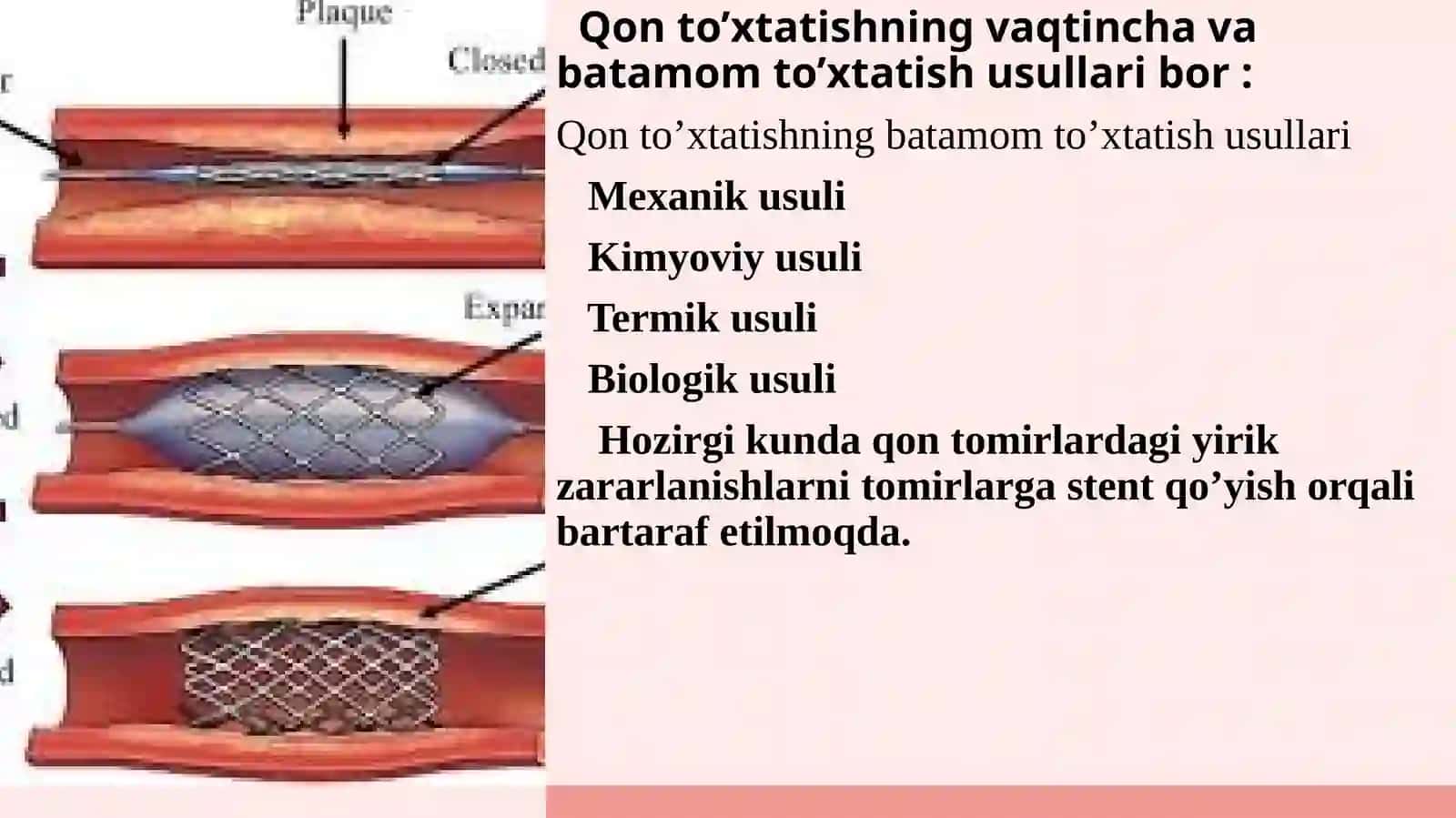 Qon to'xtatish usullarida zamonaviy stendlardan foydalanish umumiy xirurgiyadan 4