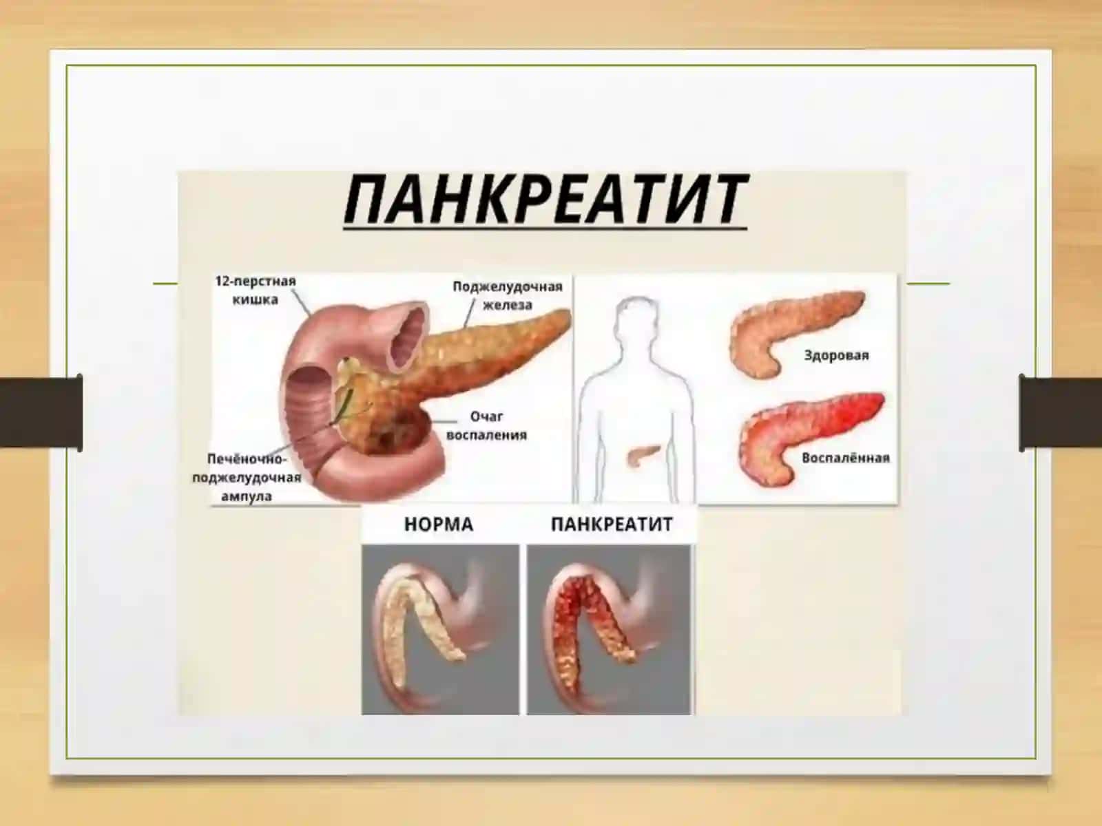 Pankreatit, kron, diareya 4