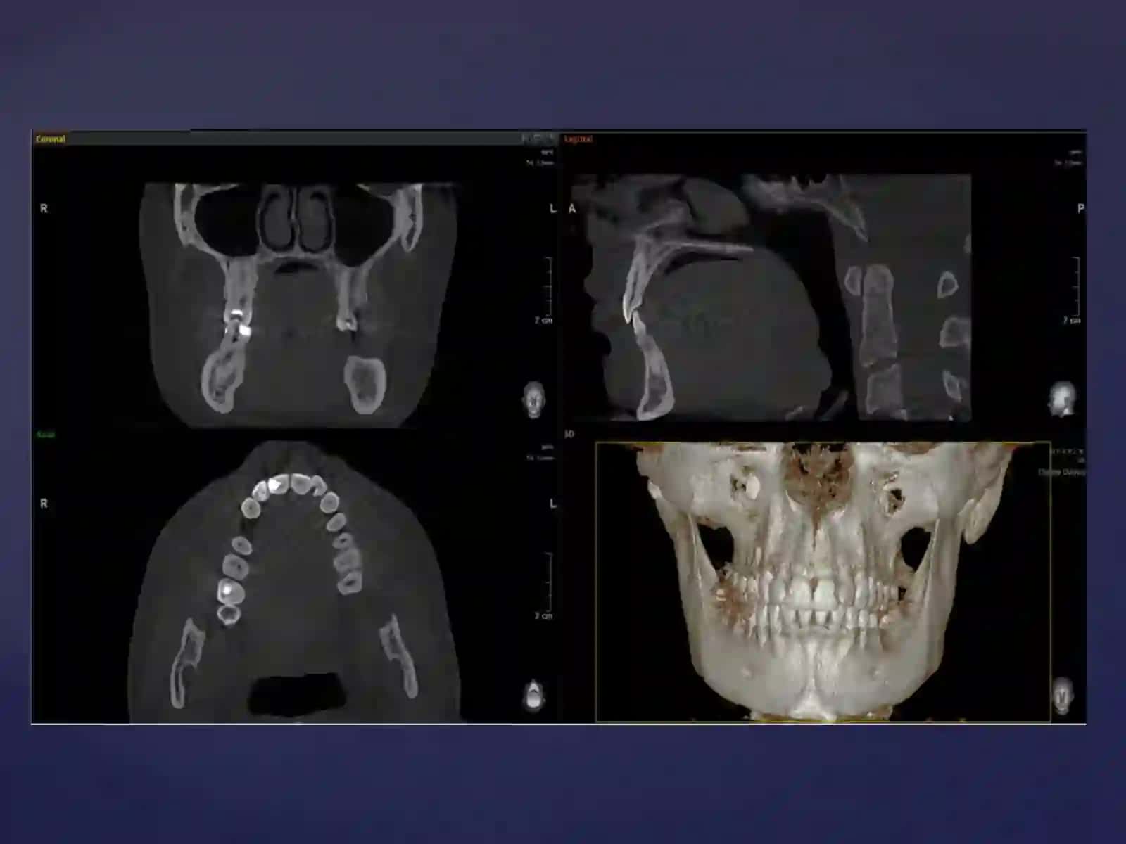 KLIKTasosida dental implantatsiyani 3D rejallash 4
