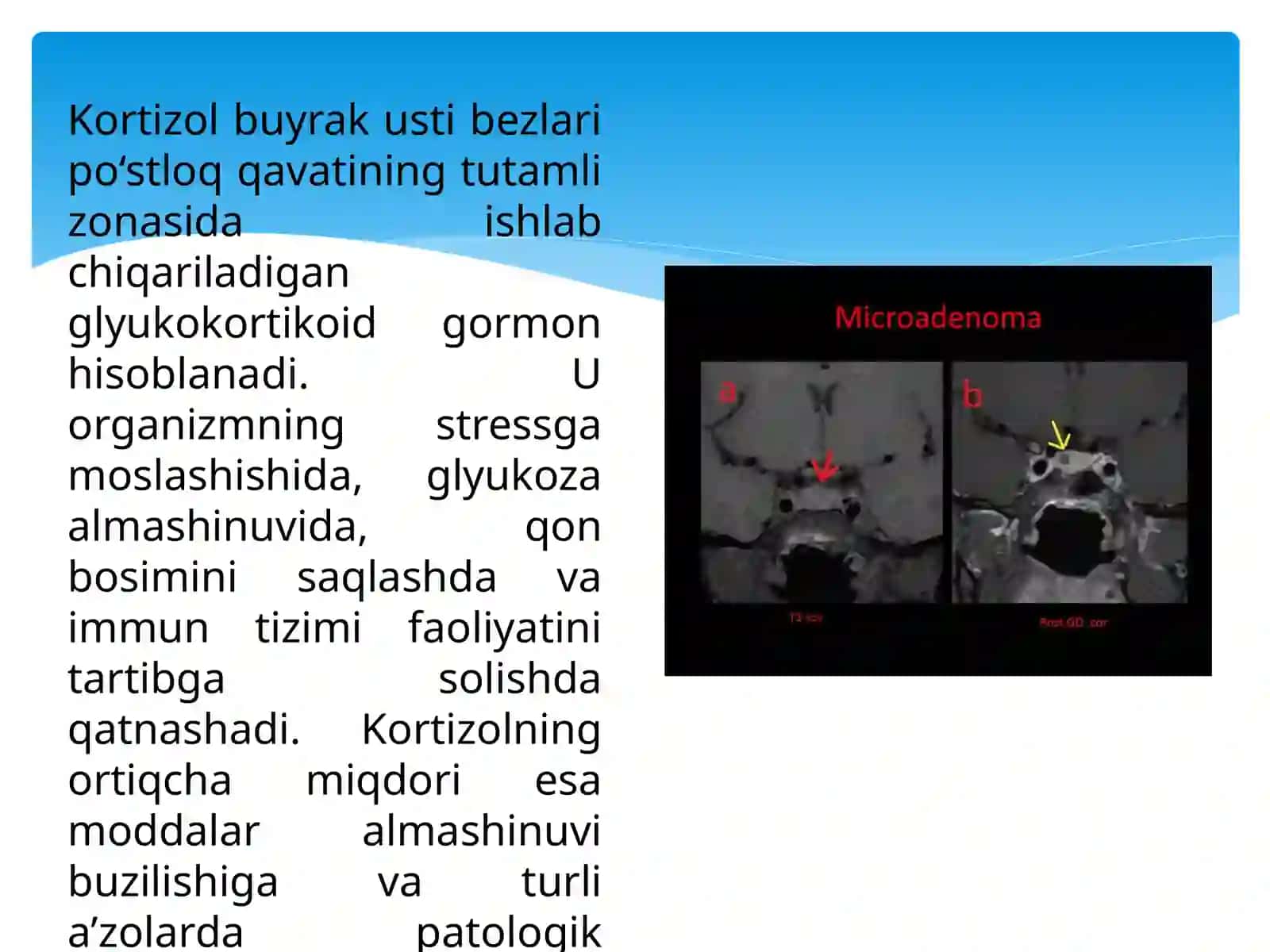 Itsenko–Kushing kasalligi 4