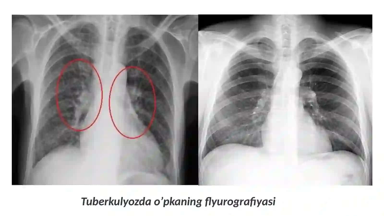 Tuberkulyoz bemorlarini davolash va kuzatish sxemalari 4