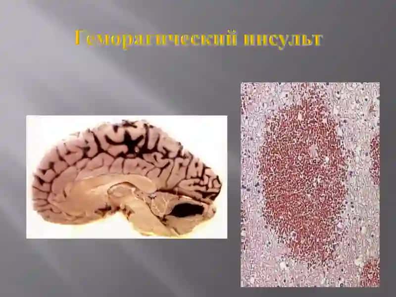 Основные клинико-морфологические проявления нарушения обмена гемоглобиногенных пигментов 4