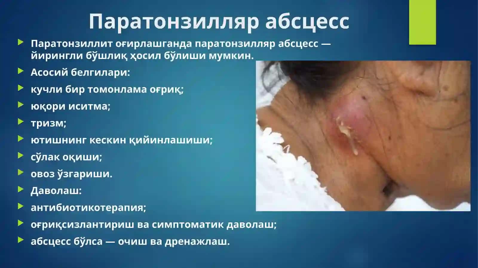 Паратонзиллит ВА 8-ТИШ ПЕРИКОРОНАРИТИ 4