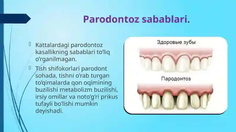 Parodontoz va uning sabablari 4
