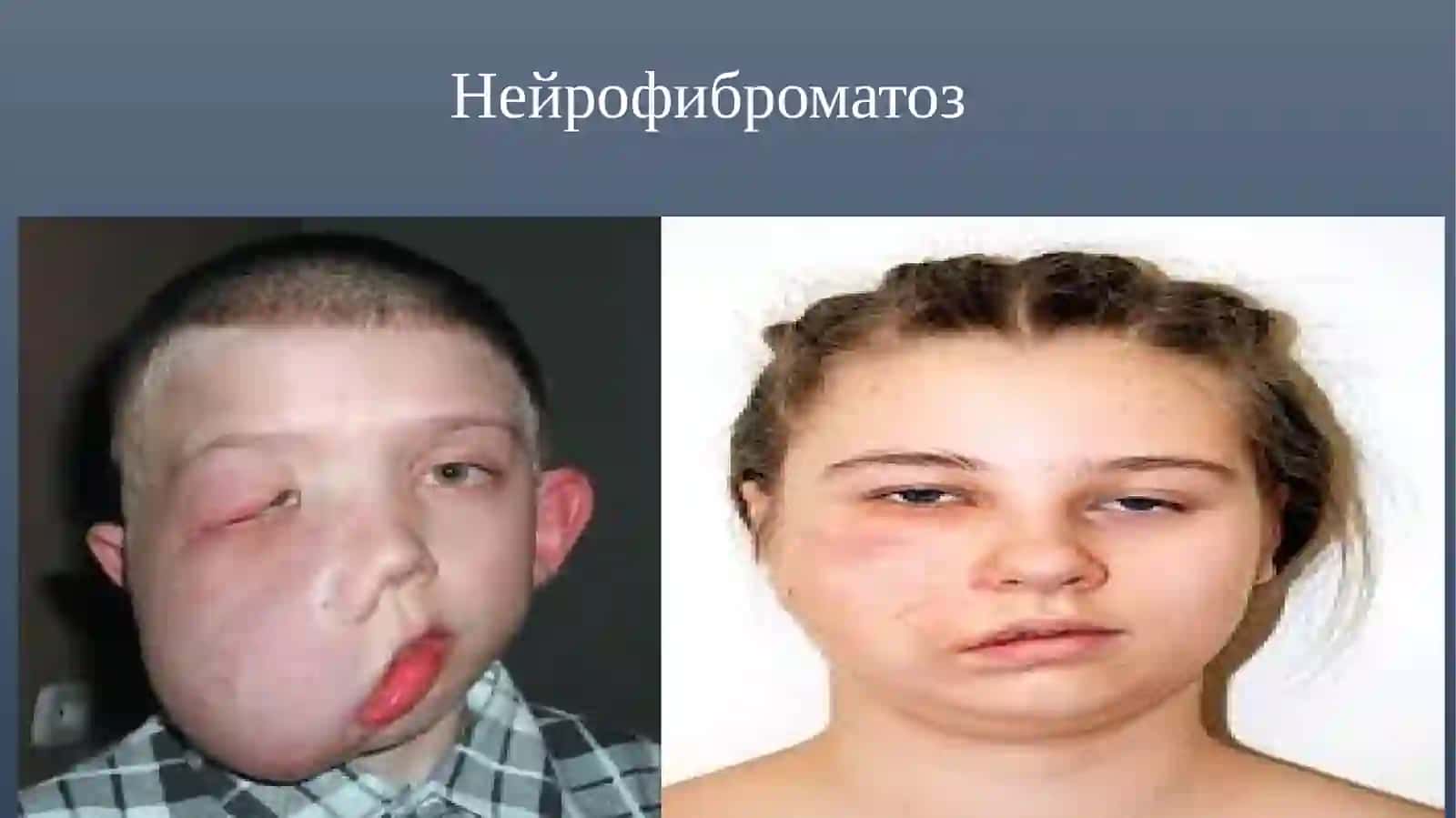 Нейрофиброматоз 4