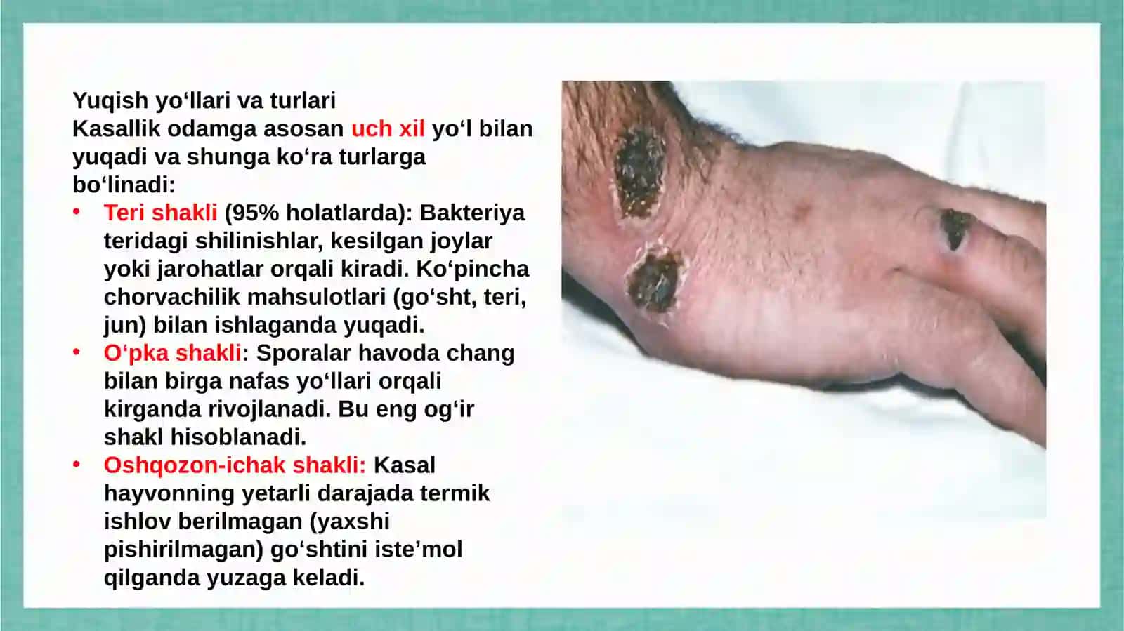 Oʻta xavfli infeksiya kuydirgi va brutsellyoz tasnifi 4