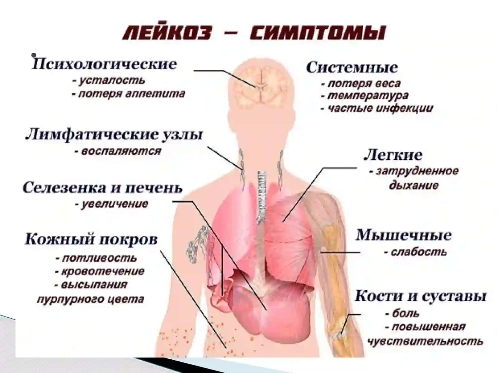 Хронический лимфолейкоз 4