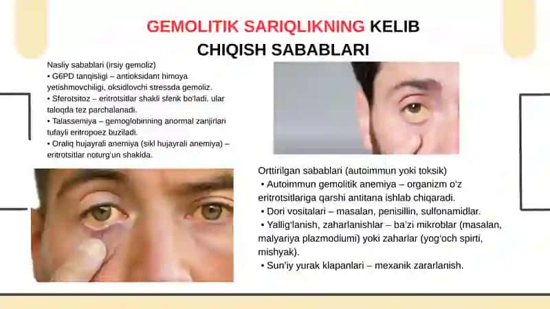 SARIQLIKGABOGʻLIQ SINDROMLAR 4