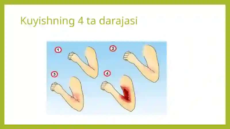 Kuyishkasalligi 4