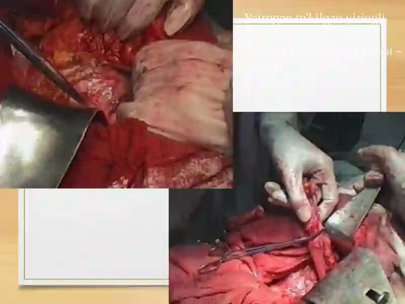 Peritonit(peritonitis) 4