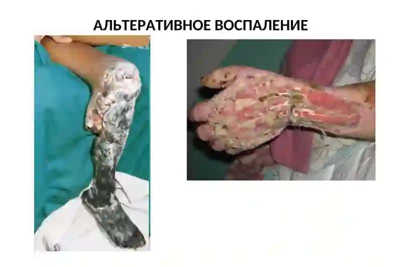 Воспаление 4