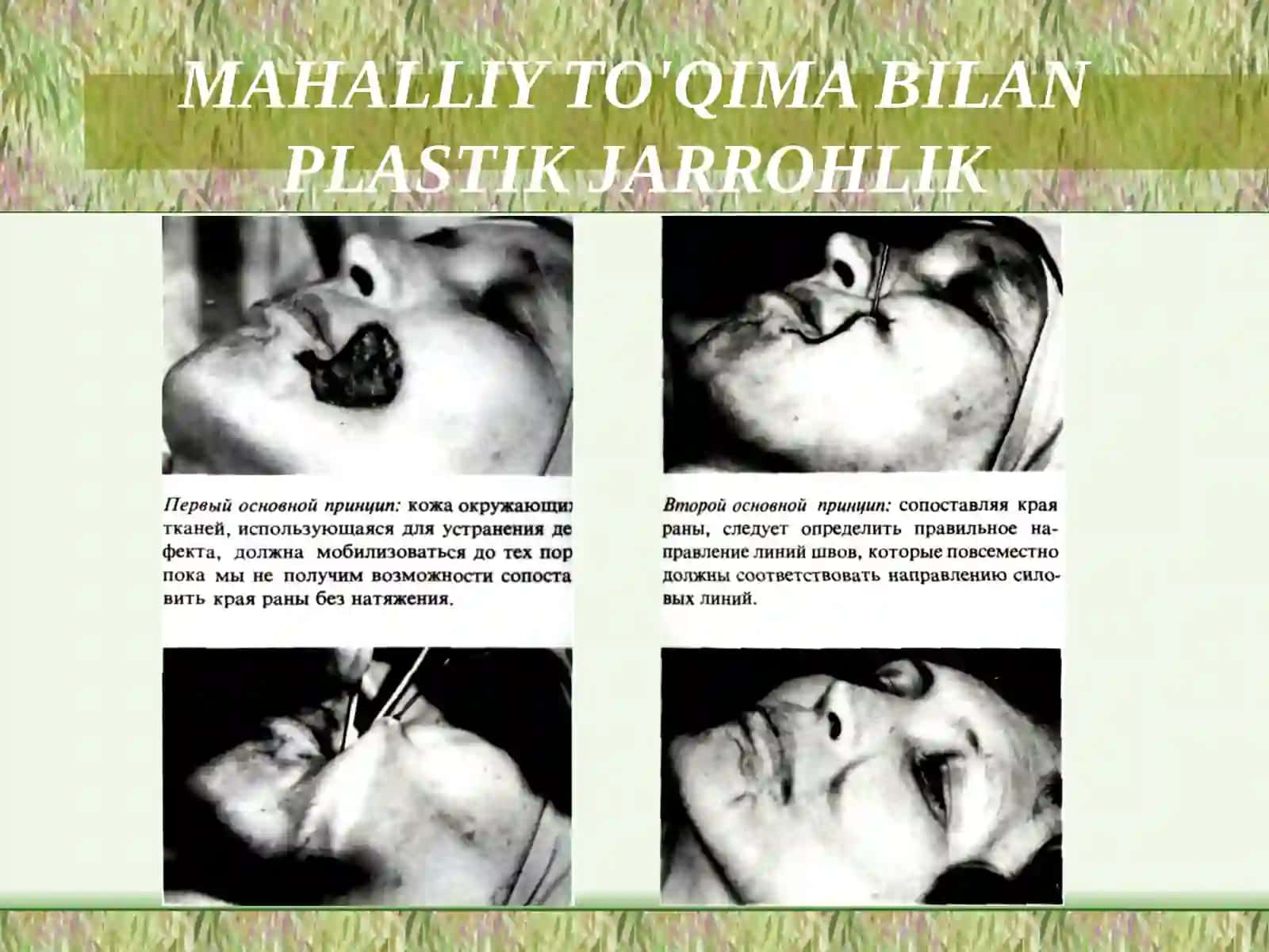 Mahalliy to‘qimalar bilan plastika qilish: Limberg uchrashuvchi uchburchakli laxtaklar. Ko’rsatmalar. Turlari va o‘tkazish prinsiplari. 4