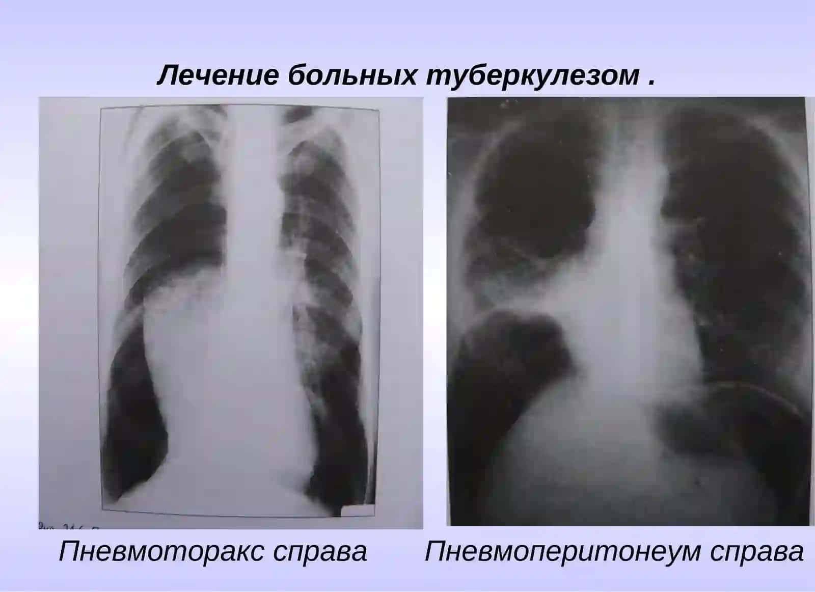 Лекция №13: Основные принципы лечения больных туберкулезом 4
