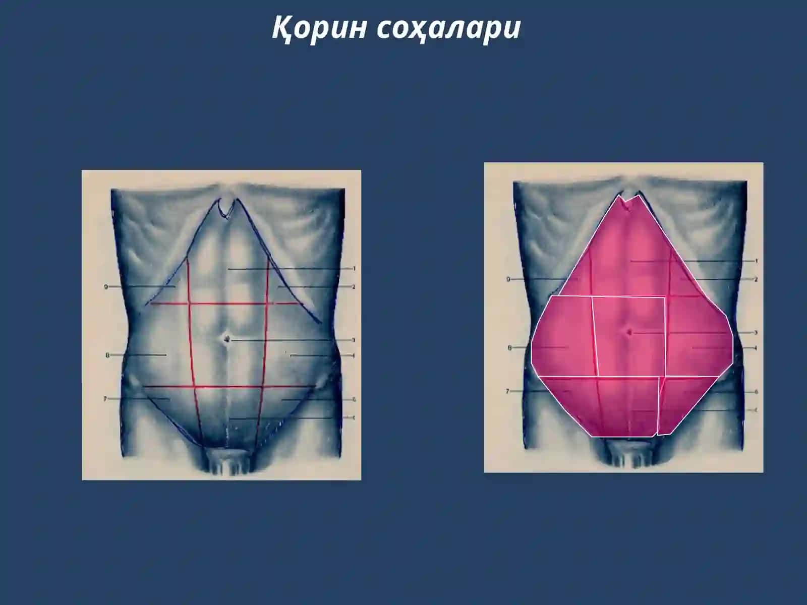 Гинекологик перитонитлар 4
