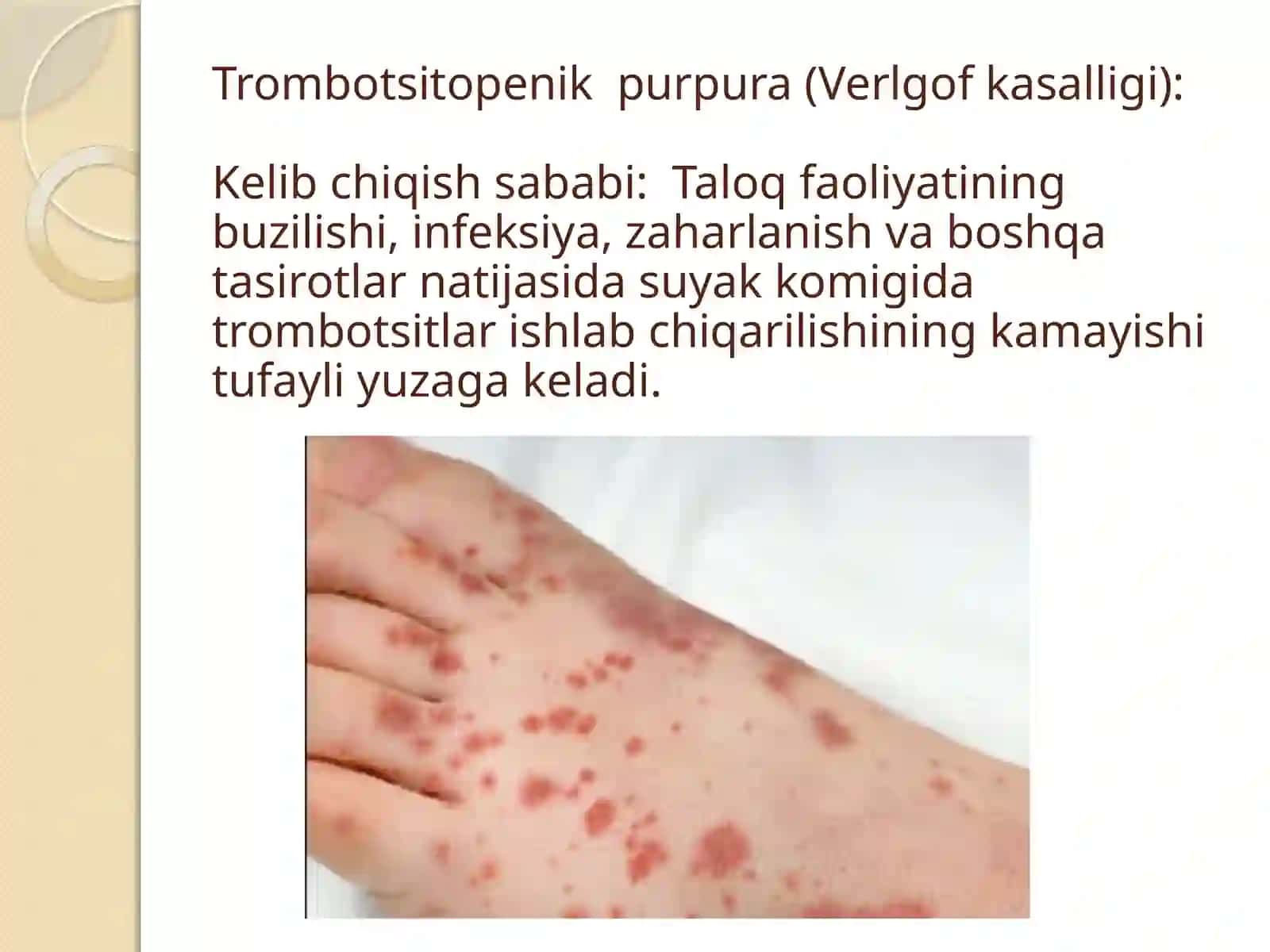Gemorragikdiatezlarningko’rinishlari 4