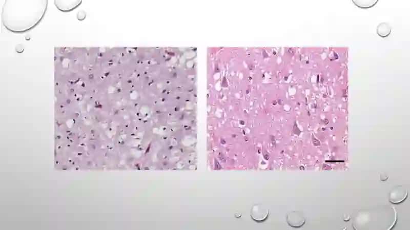 Prion kasalliklari 4