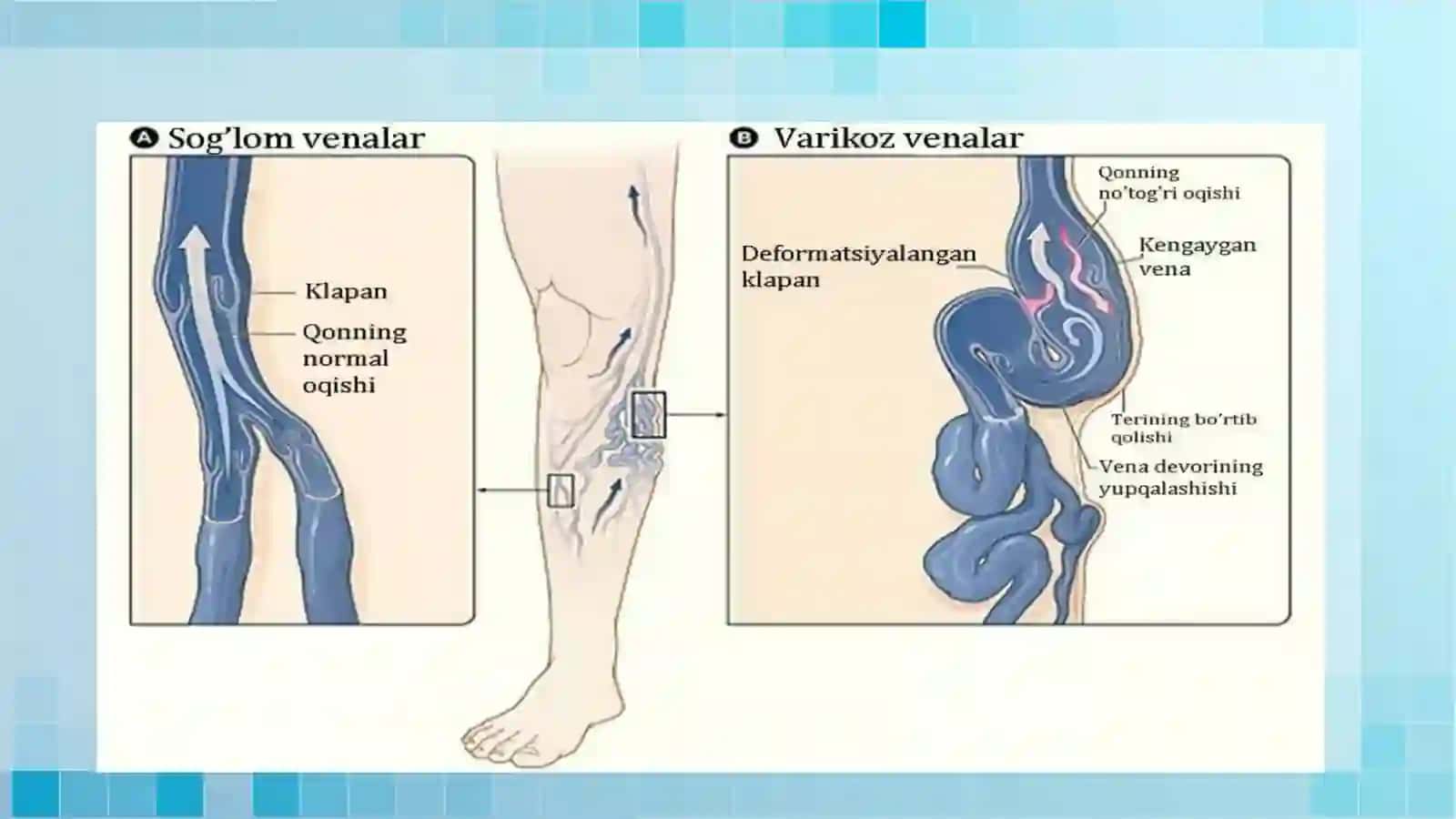 Son varikoz kengayishida o‘tkaziladigan operatsiyalar 4