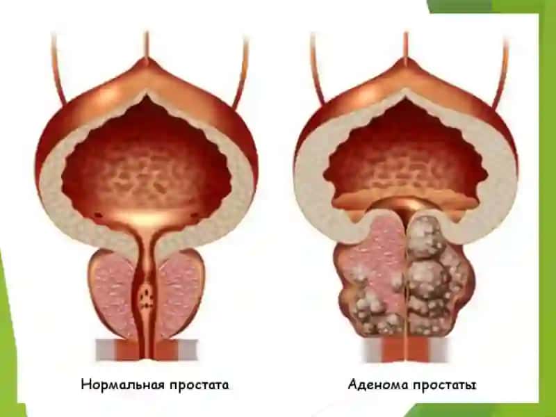 Prostata bezi o'smalari 4