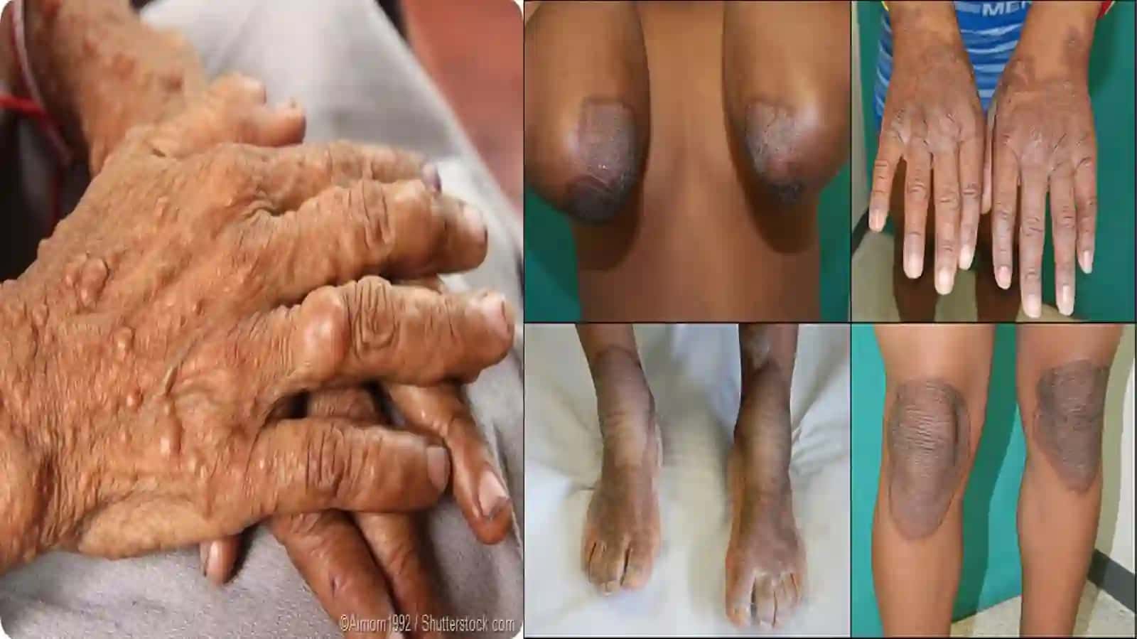 Genodermatozlar 4