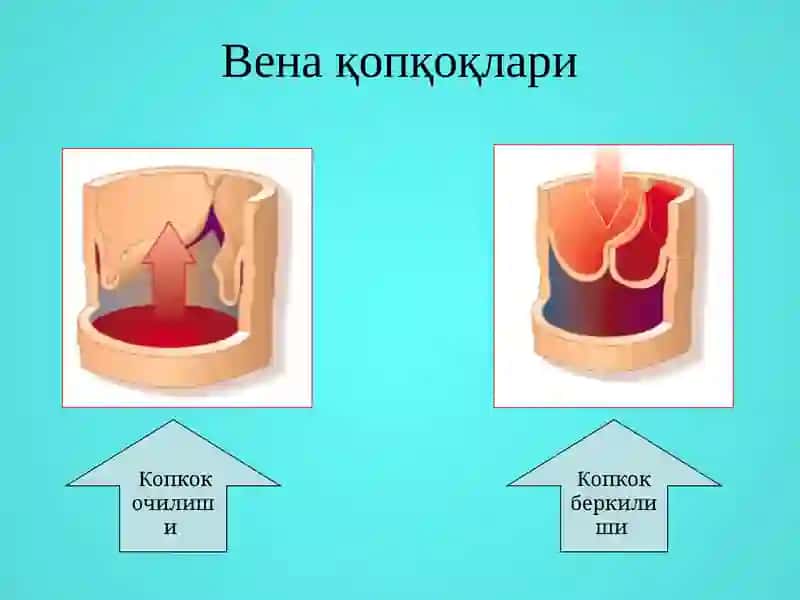Varikoz kasalligi 4