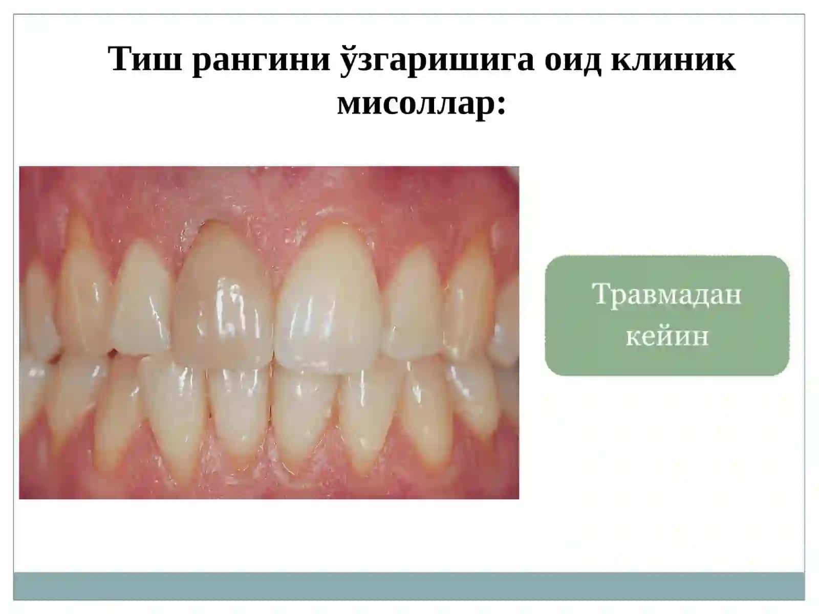Тиш ранжи 4