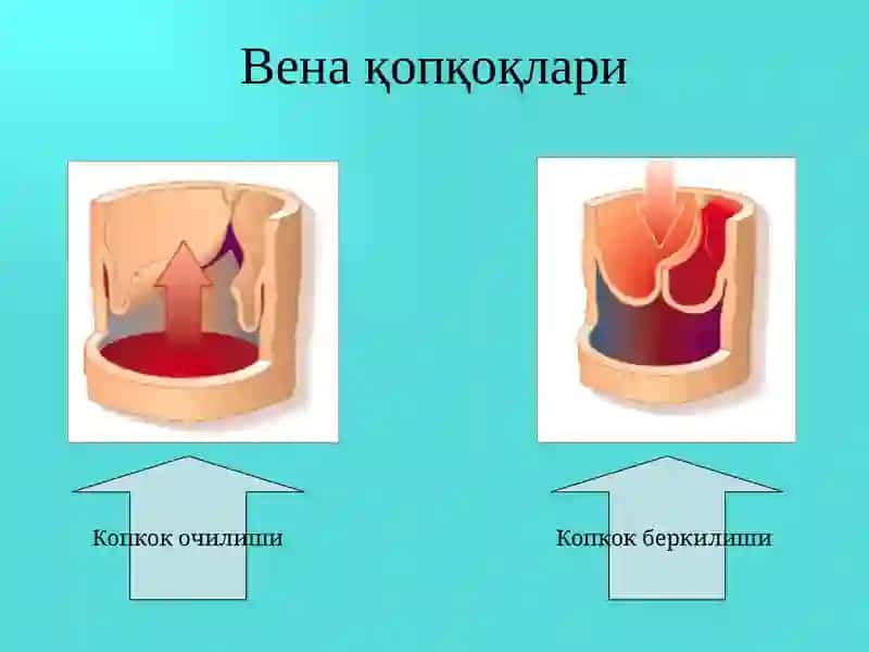 Оёқ веналарининг варикоз касаллиги 4