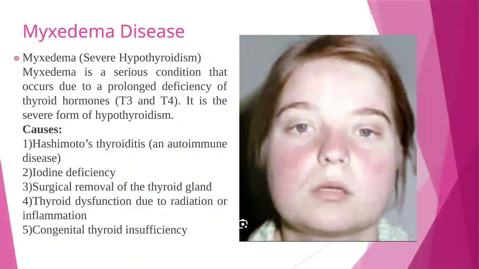 Thyroid disorders 4