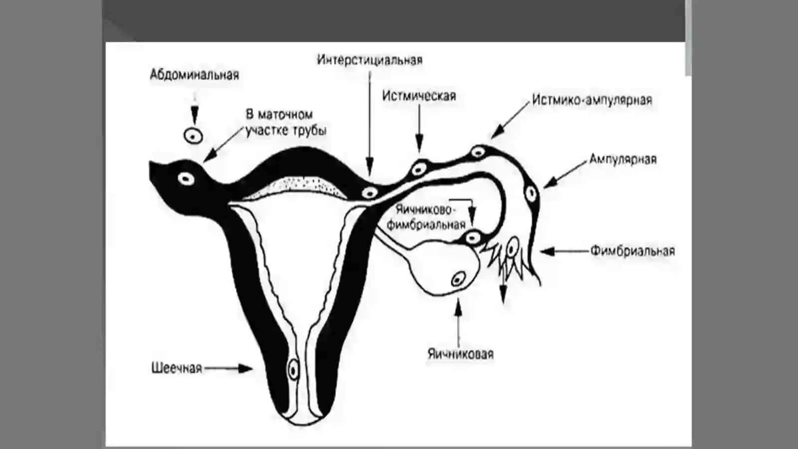 Genikologik amalyotda o’tkir qorin kasalliklari 4
