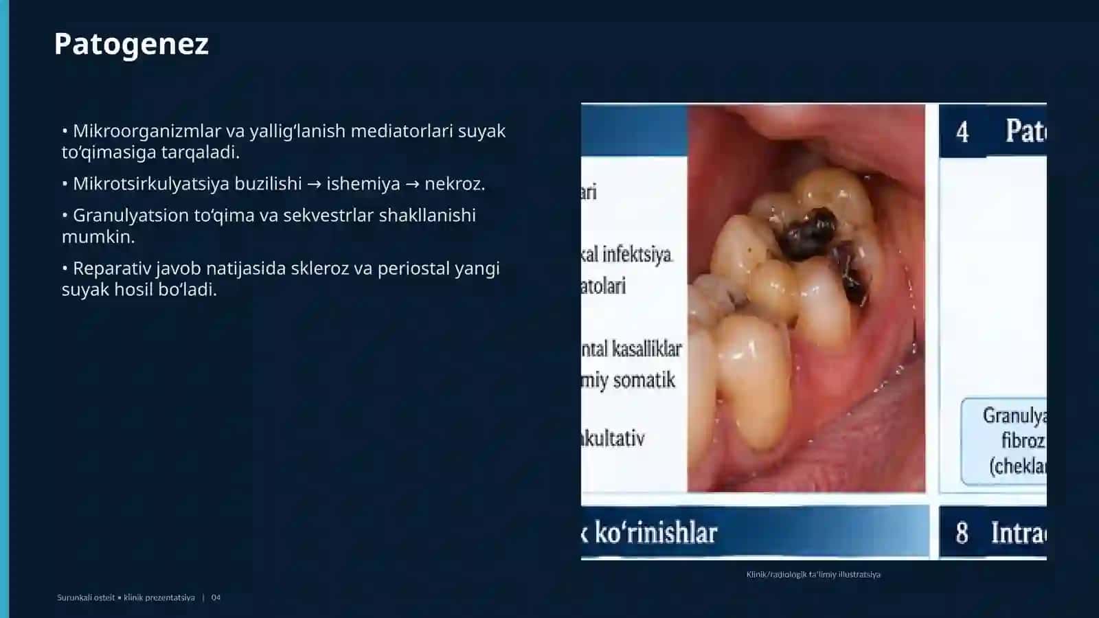 SURUNKALI OSTEIT 4