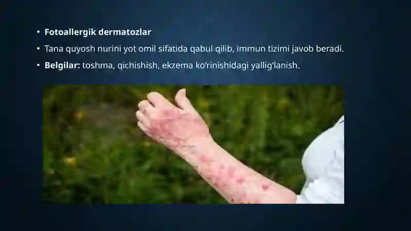 Fotodermatozlar 4
