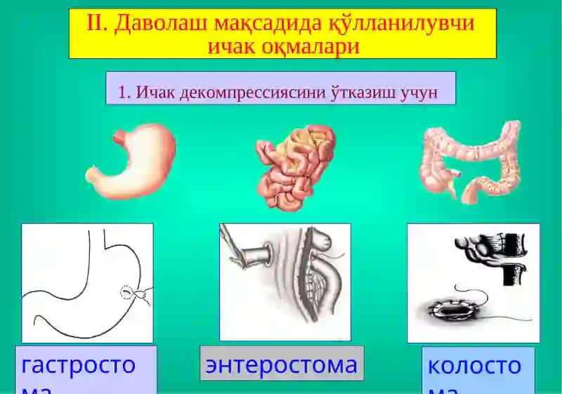 Ичак оқмалари 4