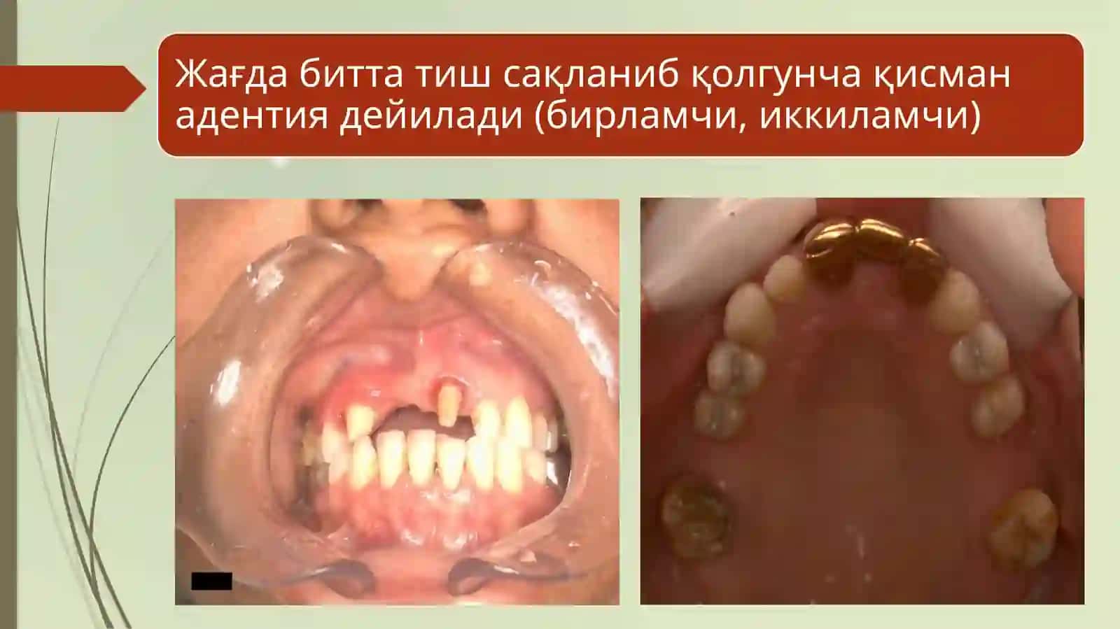 Тиш қаторлари деформатсияларини бартараф этишнинг аппаратур-физиотерапевтик ва ортодонтик усуллари 4