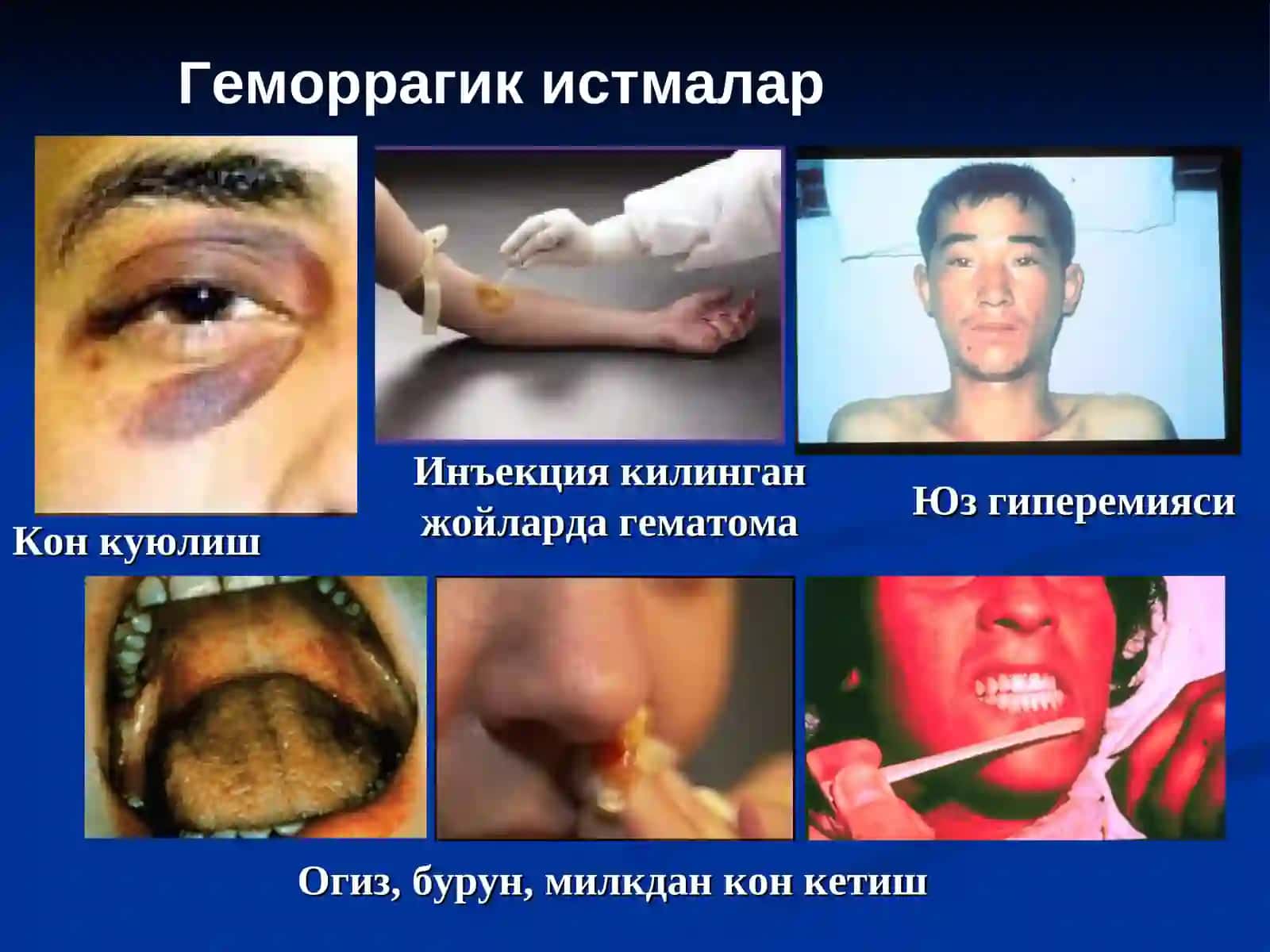 Геморрагик истмалар 4