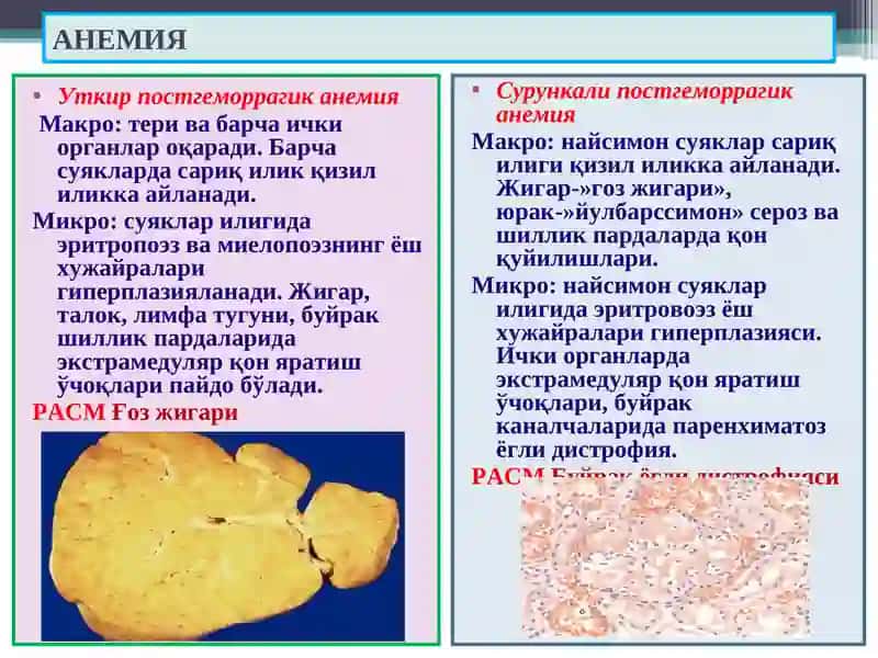 АНЕМИЯ 4