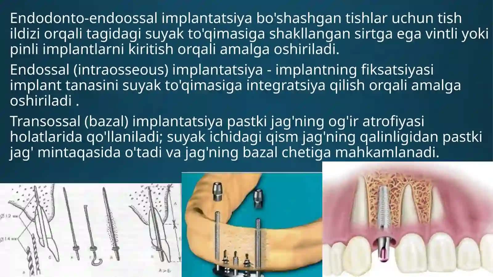 To'liq olib qo'yiladigan protezlarni implantlar bilan fiksatsiya qilish turlari 4