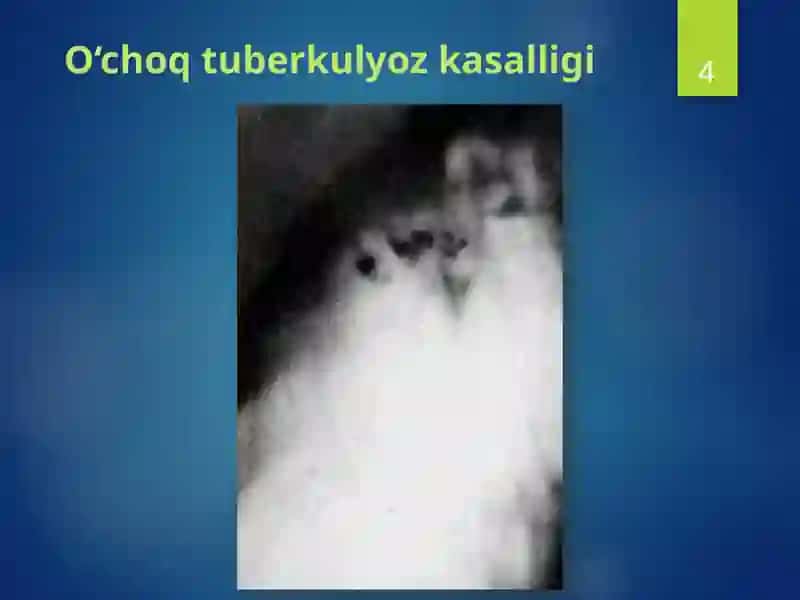 Tuberkulyoz Kasalligi 4