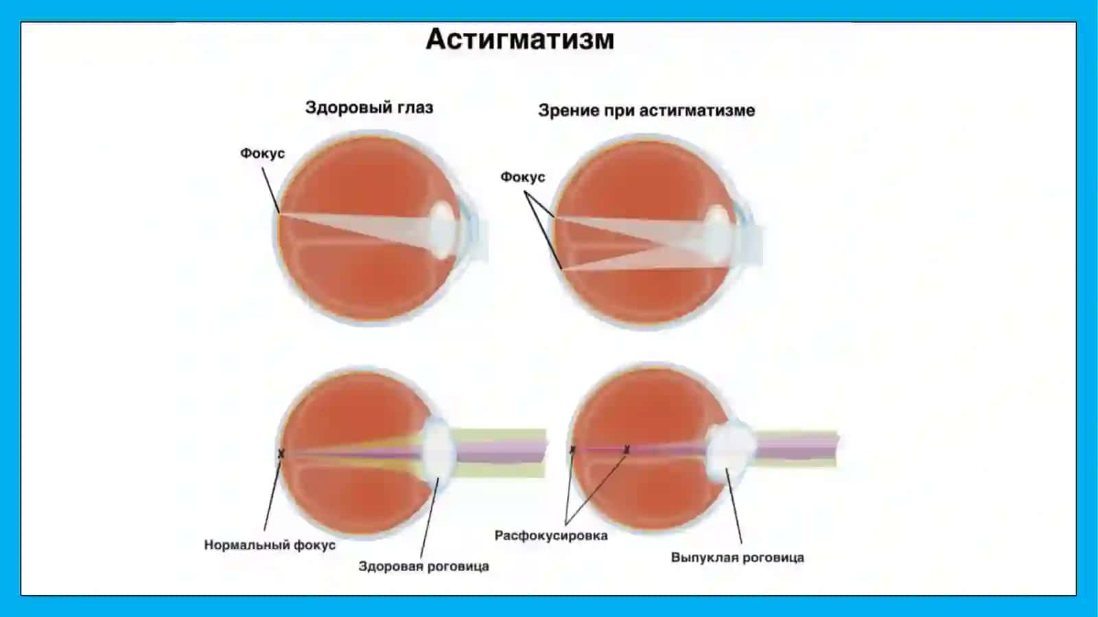 АСТИГМАТИЗМ.ВИДЫ АСТИГМАТИЗМА. КОРРЕКЦИЯ АСТИГМАТИЗМА 4