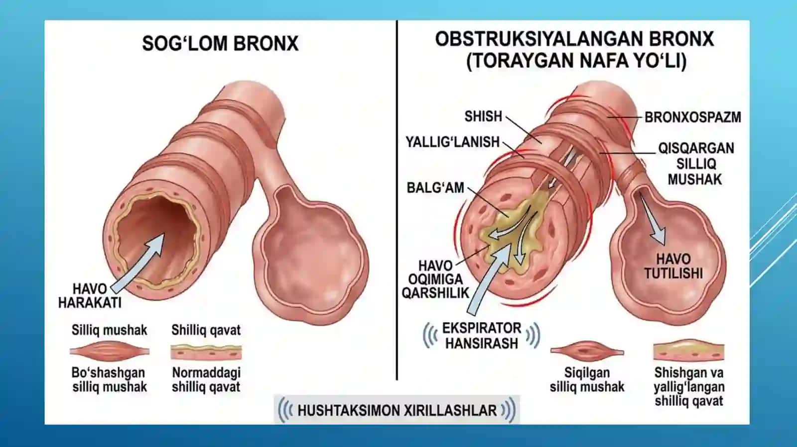 Bronxiar o'tkazuvchanligini buzilishi sindromi. O'tkir valsurunkali bronxitlar simptomatologiyasi. O'pka to gimasida xavoortishi sindromi. Obstruktiv o'pka kasalliklari bilan kasallanganbemorlarni tekshirish. Bronxial astma. O'pka emfizemasi 4