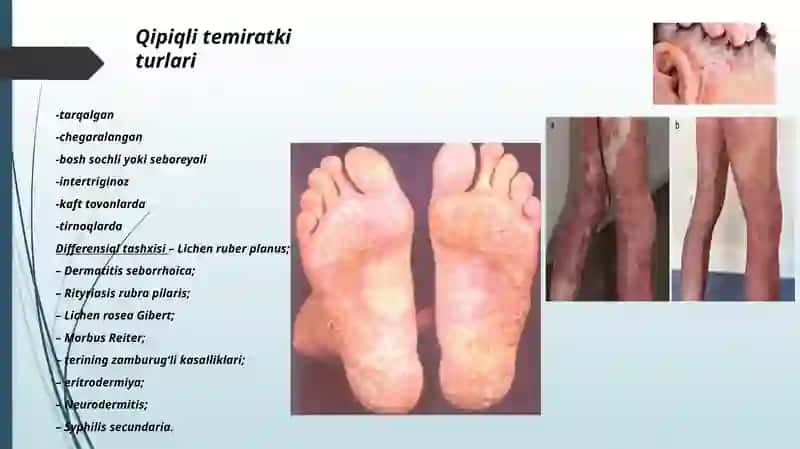 PSORIAZ VA QIZIL YASSI TEMIRATKI QIPIQLI TEMIRATKI (PSORIASISVULGARIS) 4