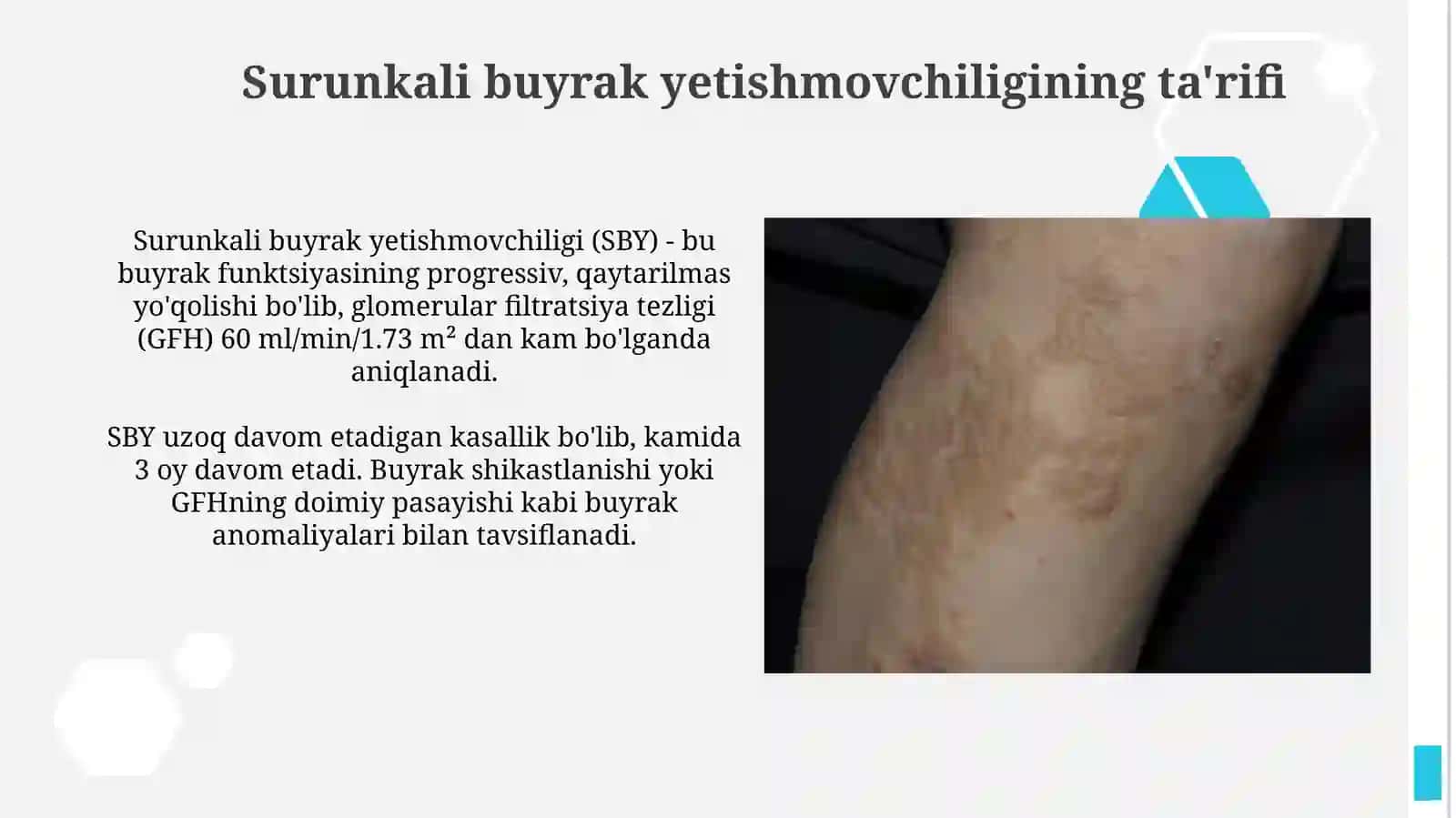 Surunkali buyrak yetishmovchiligi etiologiyasi, patogenezi, tasnifi, klinik sindromlari 4