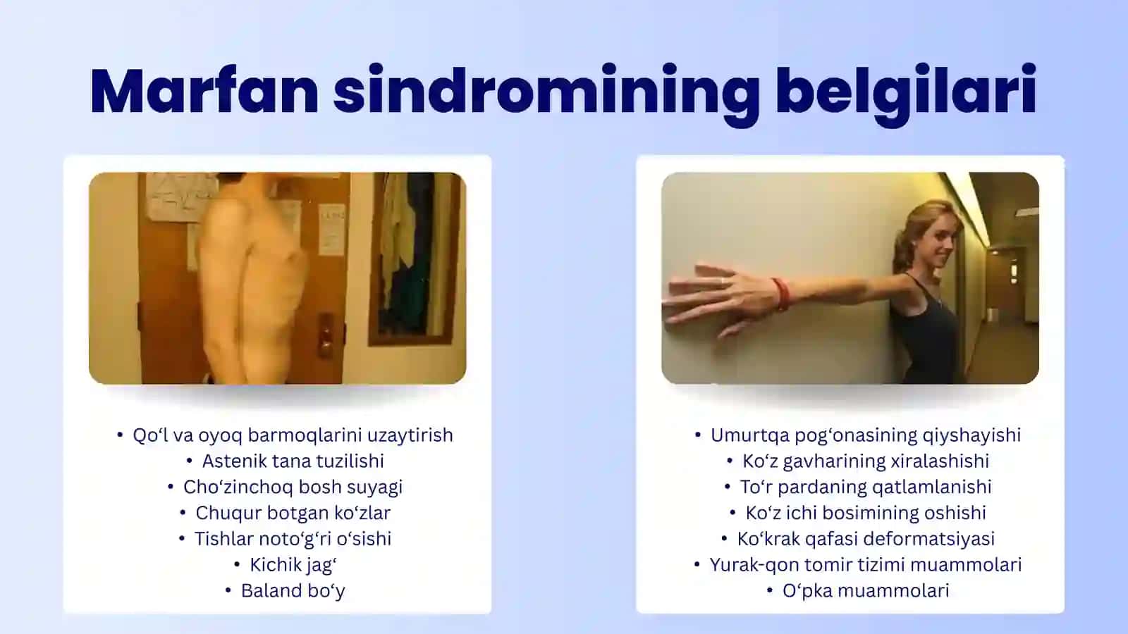 Marfan sindromi 4