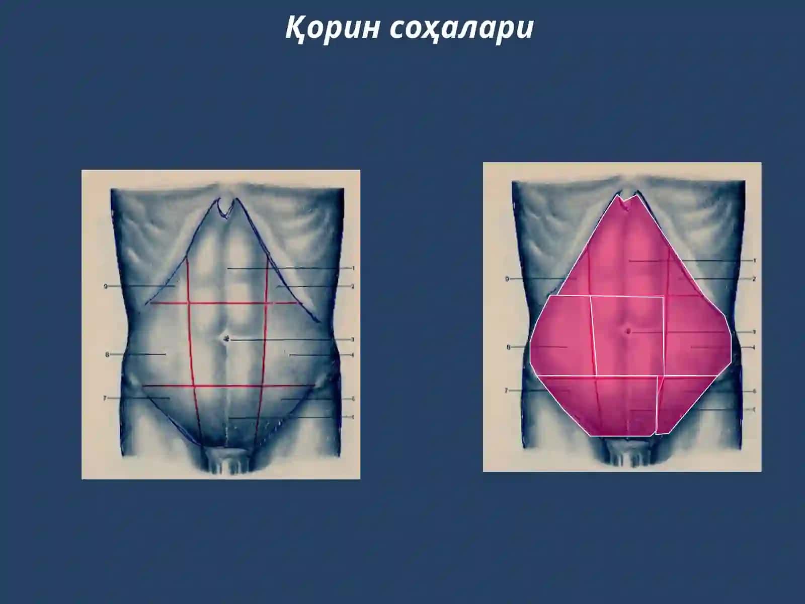 Гинекологик перитонитлар 4